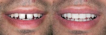 Smile Gallery - Pearly White Dental, Chicago Dentist