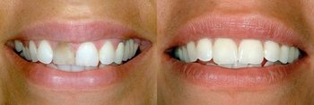 Smile Gallery - Pearly White Dental, Chicago Dentist