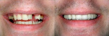 Smile Gallery - Pearly White Dental, Chicago Dentist