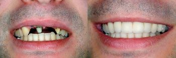 Smile Gallery - Pearly White Dental, Chicago Dentist