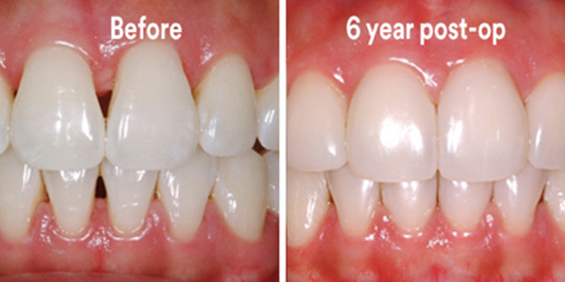 BioClear Diastema Closure and Black Triangle Closure  - Pearly White Dental, Chicago Dentist