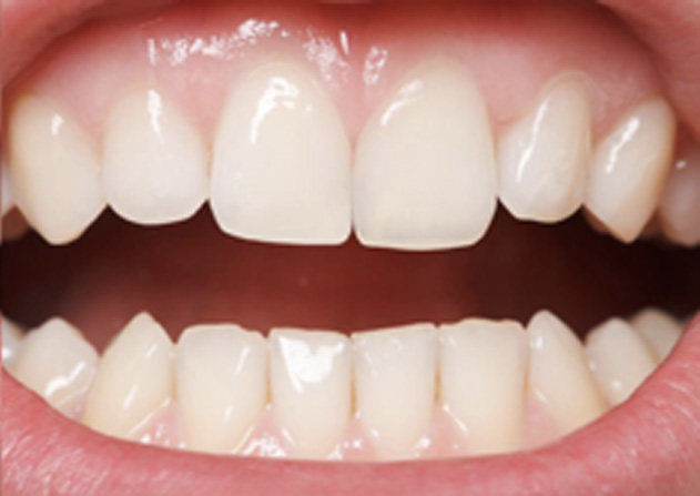 Cosmetic Bonding  - Pearly White Dental, Chicago Dentist