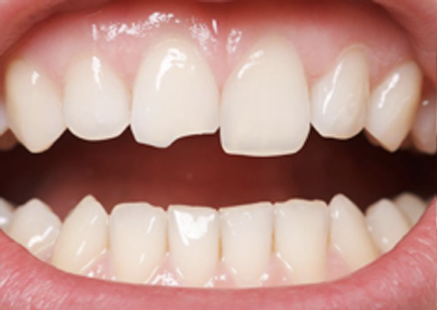 Cosmetic Bonding  - Pearly White Dental, Chicago Dentist