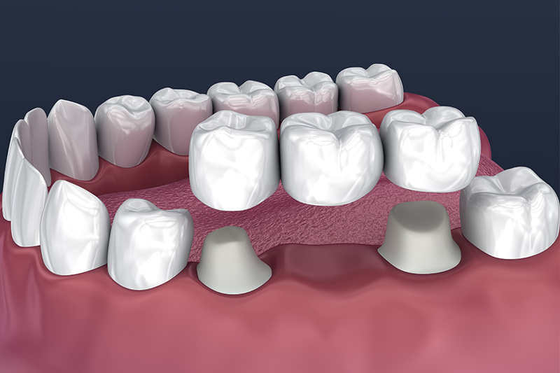 Crowns and Bridges, Inlays and Onlays  - Pearly White Dental, Chicago Dentist