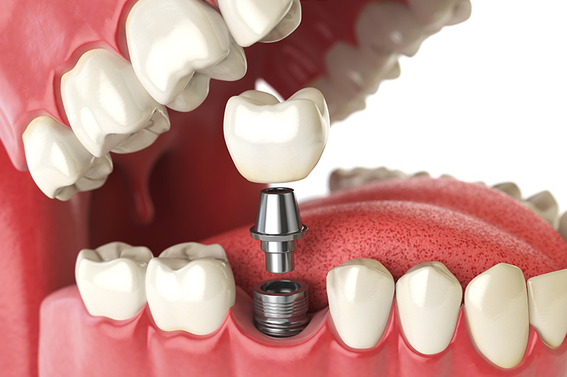 Dental Implants - Pearly White Dental, Chicago Dentist