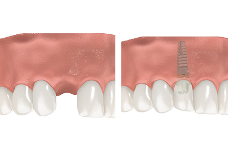 Dental Implants - Pearly White Dental, Chicago Dentist