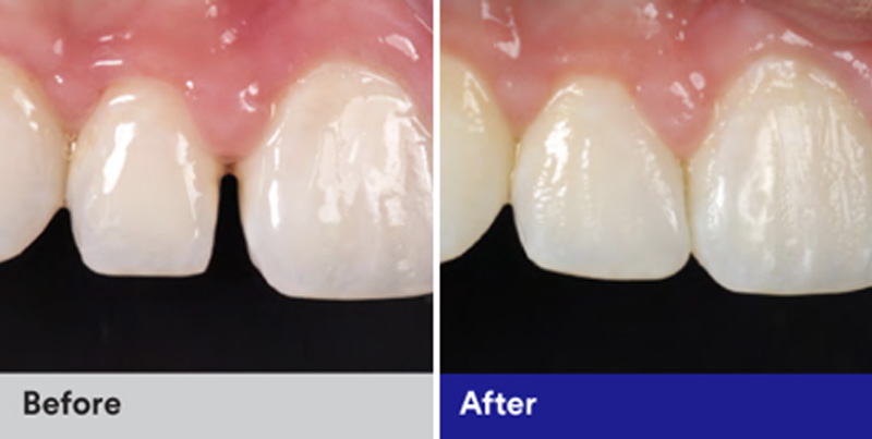 BioClear Diastema Closure and Black Triangle Closure  - Pearly White Dental, Chicago Dentist