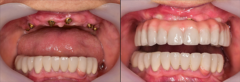 Implant Overdentures and Fixed All-On-X Treatment  - Pearly White Dental, Chicago Dentist