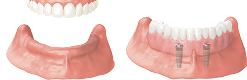 Implant Overdentures and Fixed All-On-X Treatment  - Pearly White Dental, Chicago Dentist