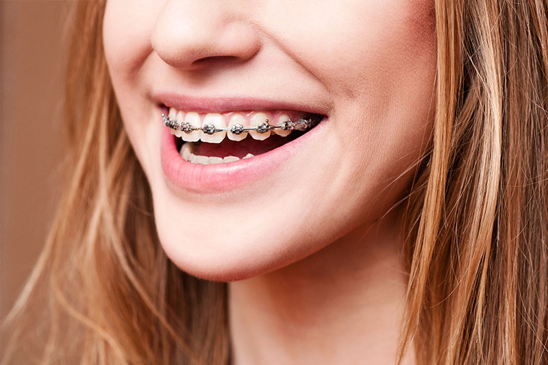 Orthodontics - Pearly White Dental, Chicago Dentist