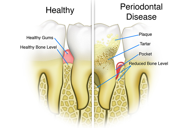 Scaling & Root Planings (Deep Cleanings)  - Pearly White Dental, Chicago Dentist