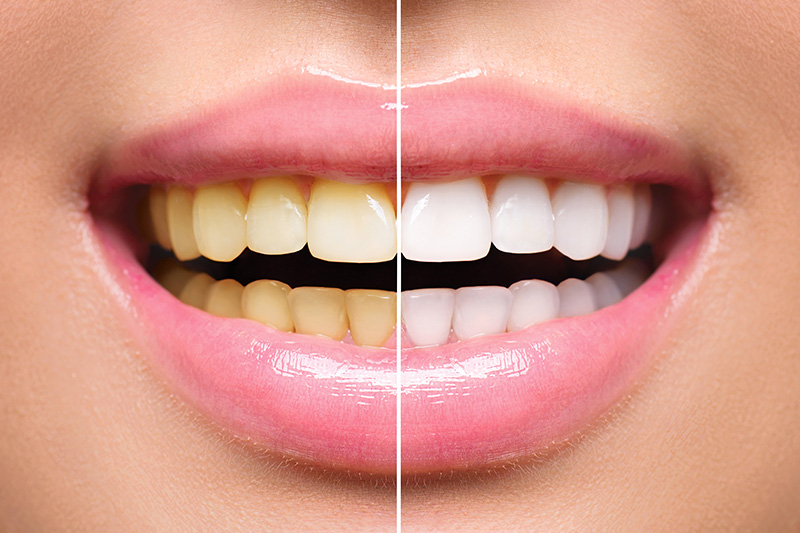 Teeth Whitening - Pearly White Dental, Chicago Dentist