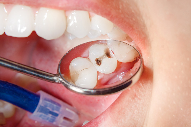 Tooth Colored Composite Fillings  - Pearly White Dental, Chicago Dentist
