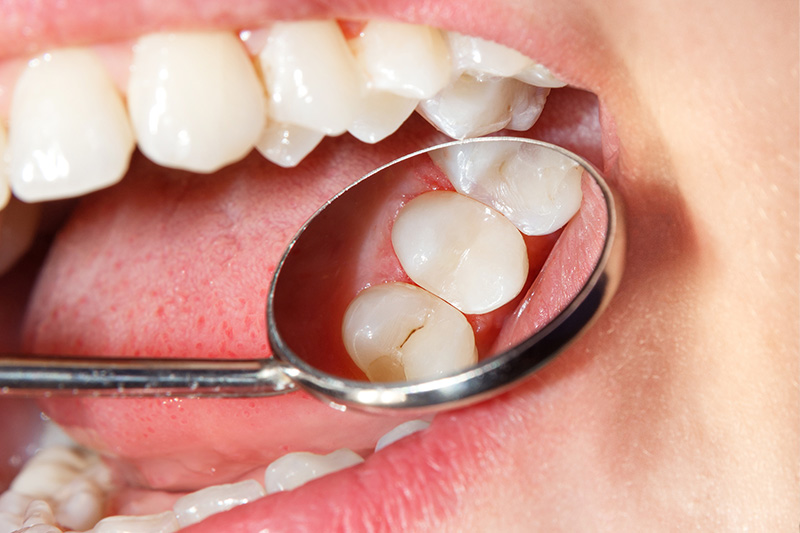 Tooth Colored Composite Fillings  - Pearly White Dental, Chicago Dentist