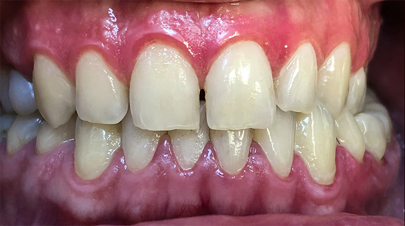 Veneers  - Pearly White Dental, Chicago Dentist