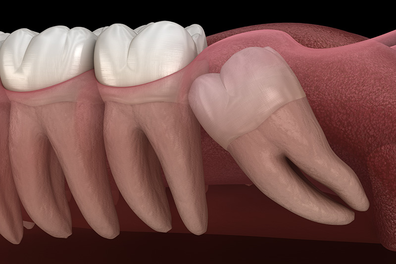 Wisdom Teeth Extractions (with Sedation)  - Pearly White Dental, Chicago Dentist